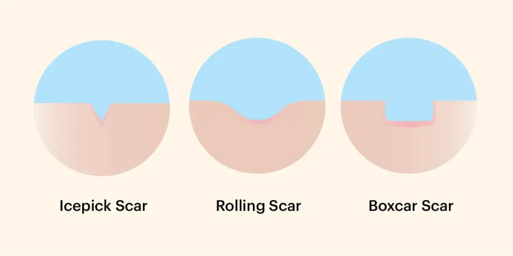 3. หลุมสิวแอ่งกะทะ (Rolling Scar)