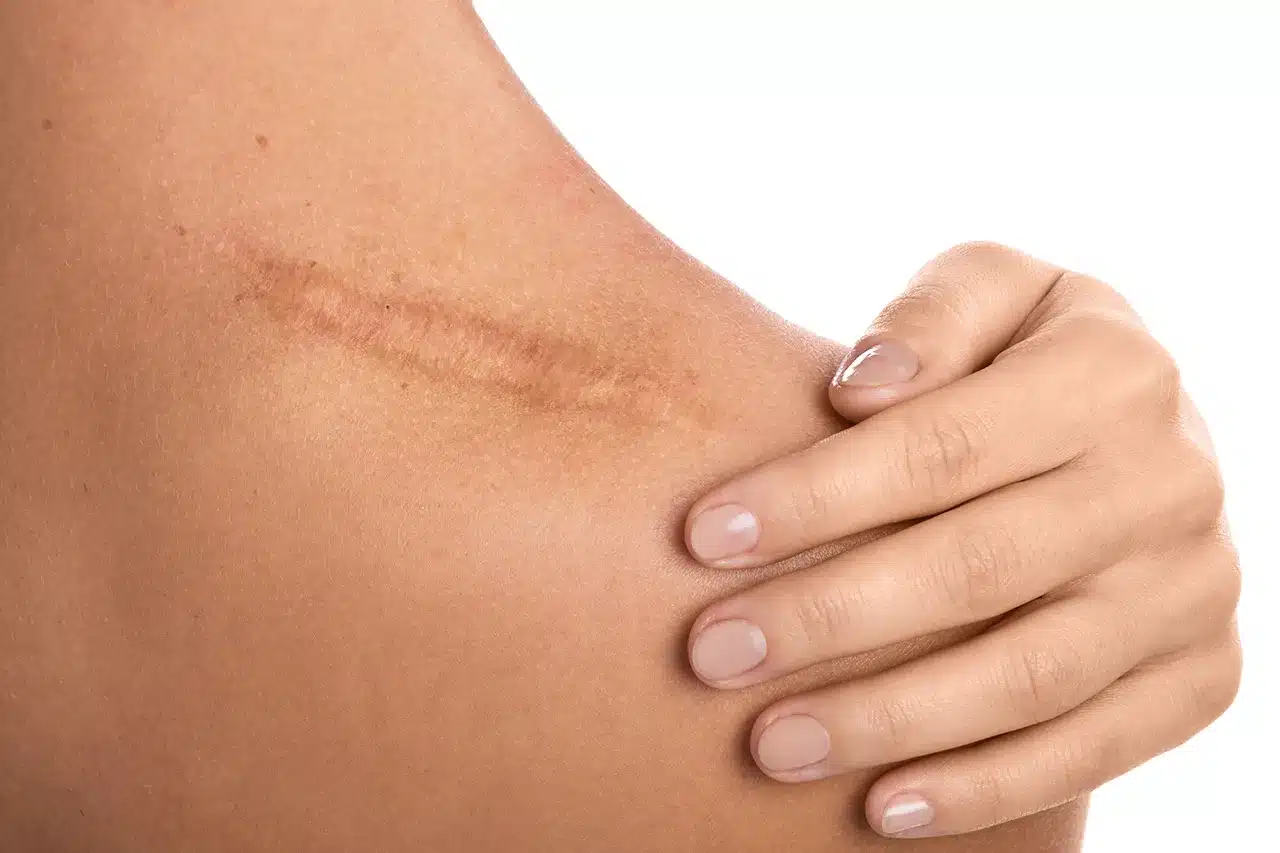 คีลอยด์ (Keloid) แผลเป็นนูนที่รักษาได้ พร้อมวิธีป้องกันไม่ให้ลุกลาม