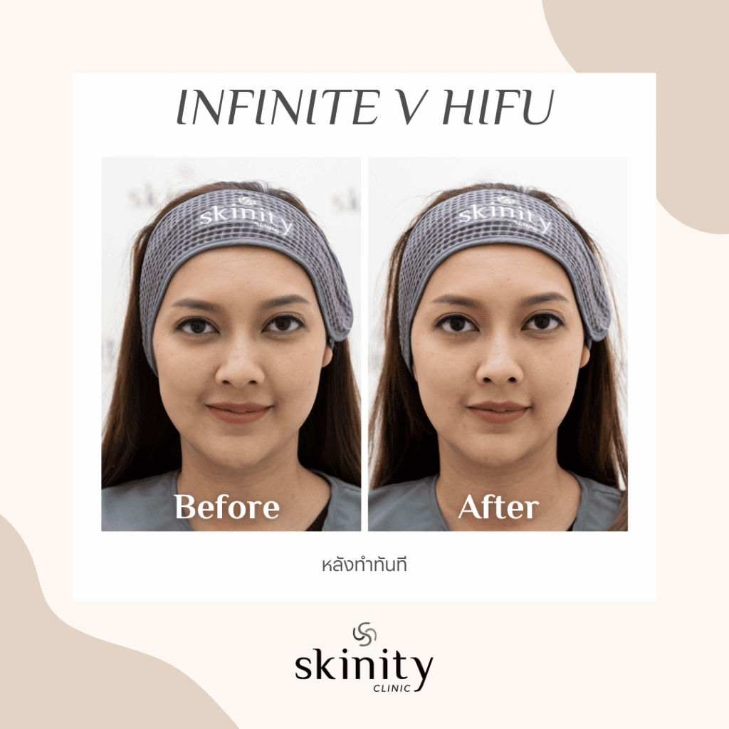ภาพก่อนและหลังทำ HIFU