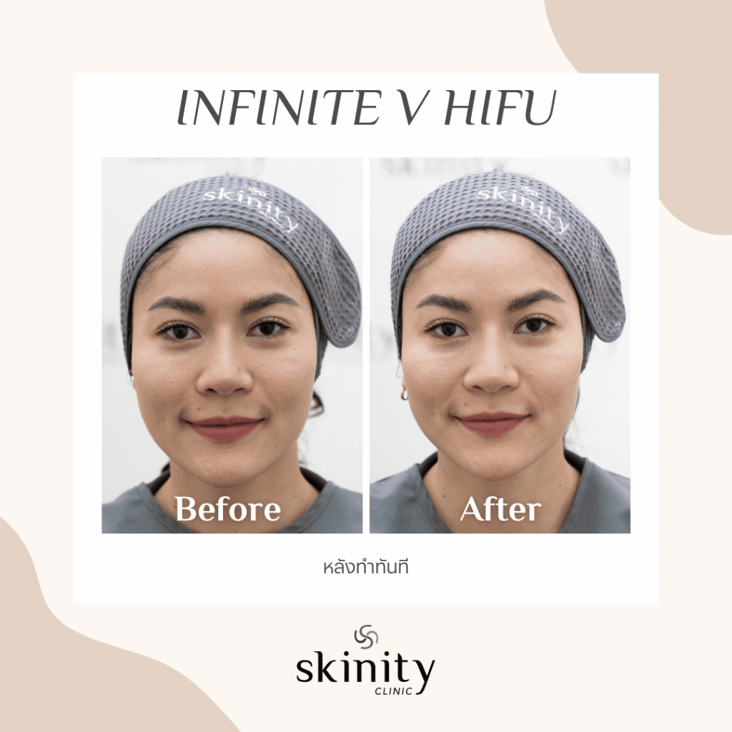 ภาพก่อนและหลังทำ HIFU