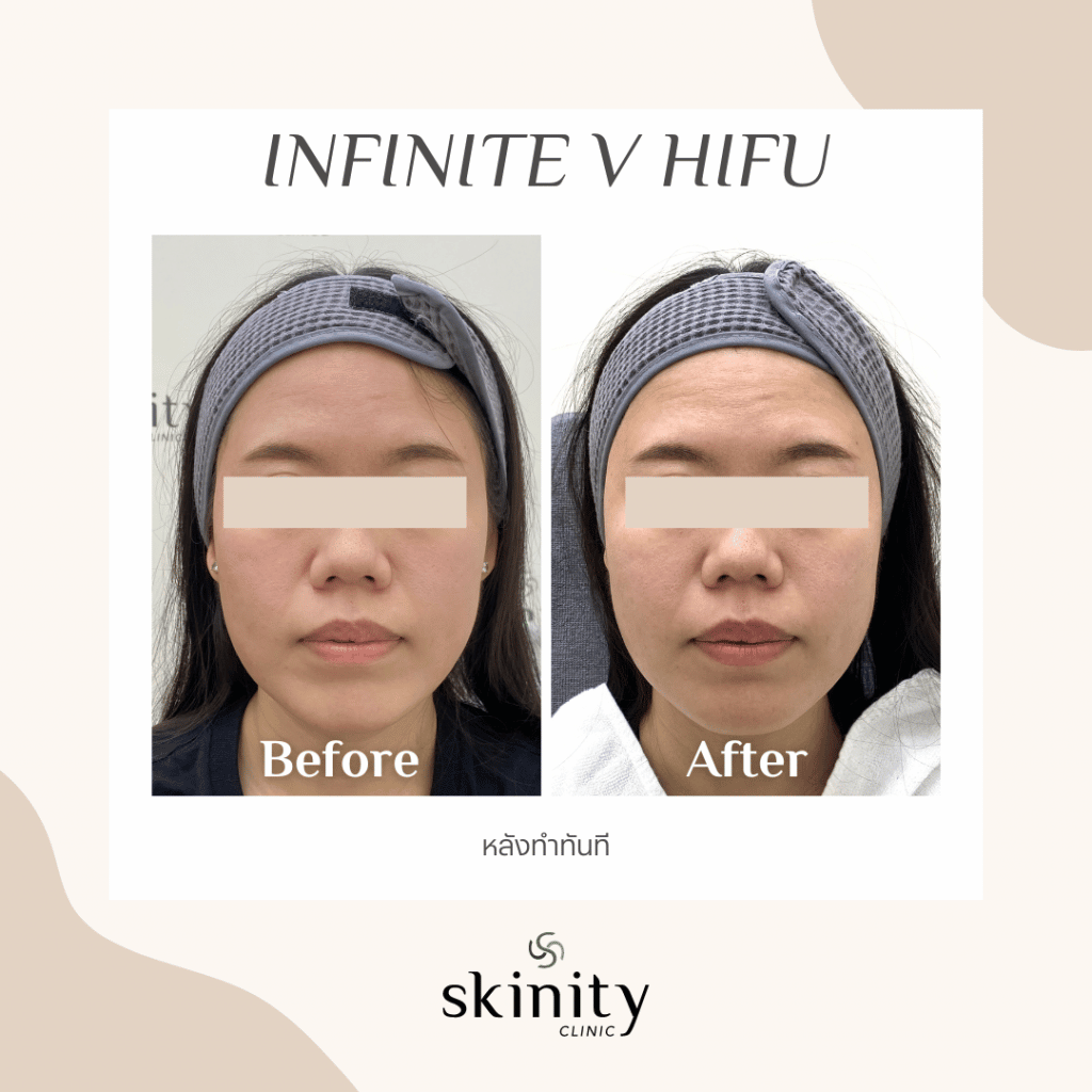 ภาพก่อนและหลังทำ HIFU