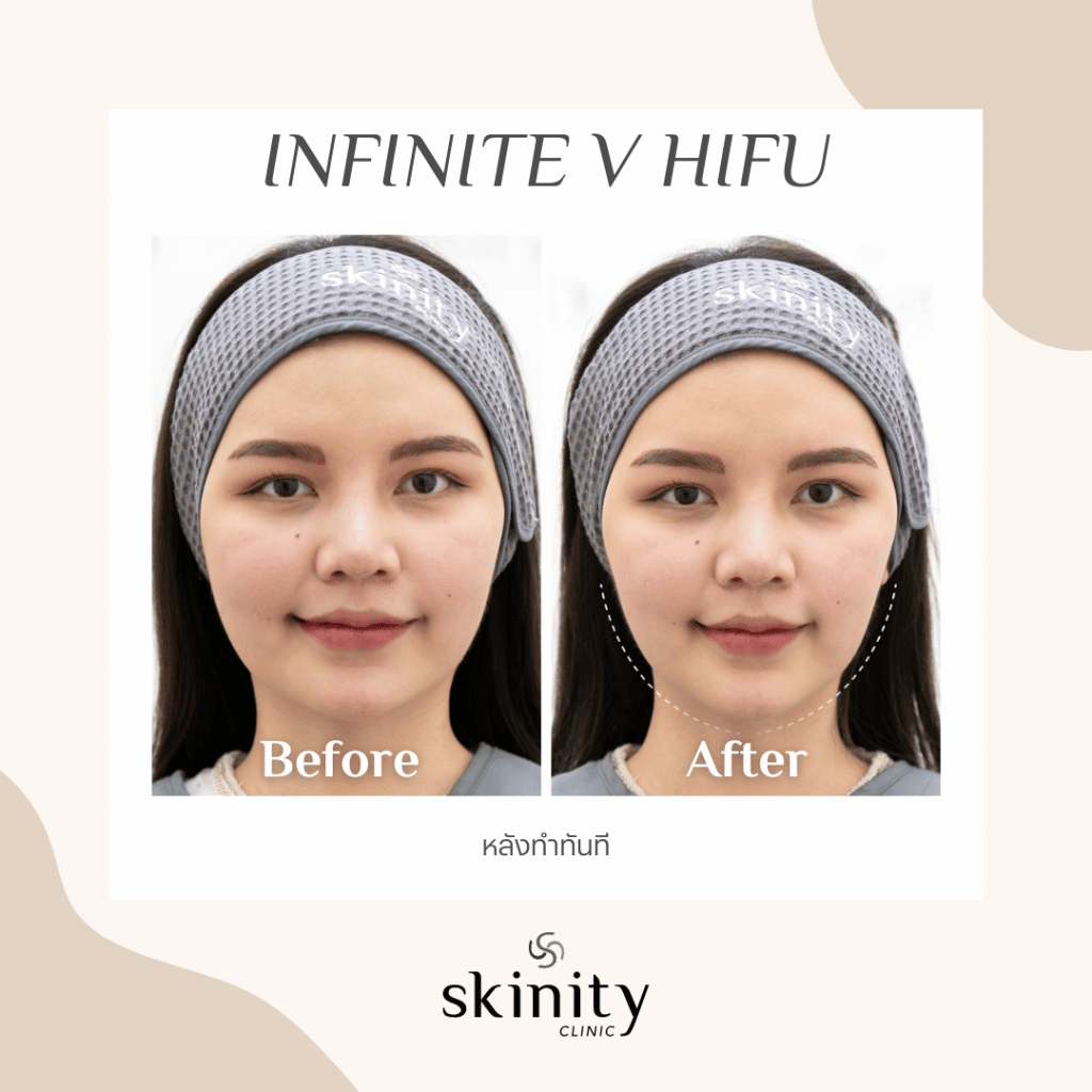 ภาพก่อนและหลังทำ HIFU