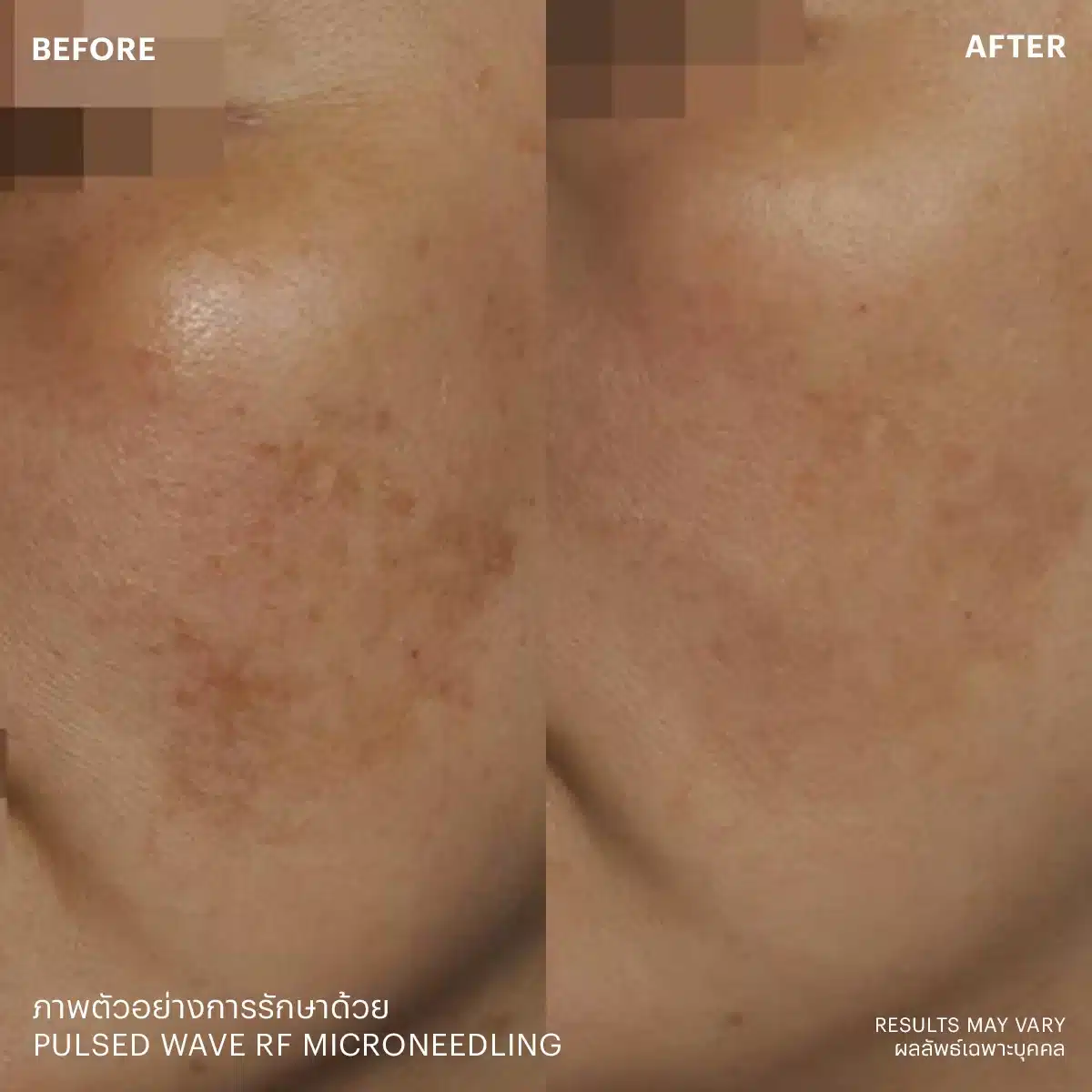 Pulsed Wave RF Microneedle (Sylfirm X)