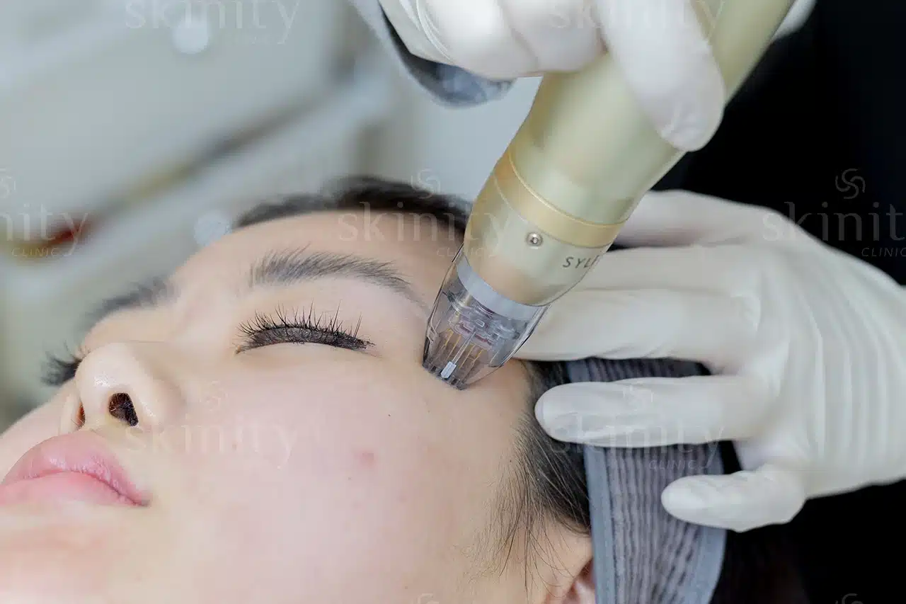 Comparing Potenza, Morpheus8, and Sylfirm X: Which Skin Treatment is Right for You?