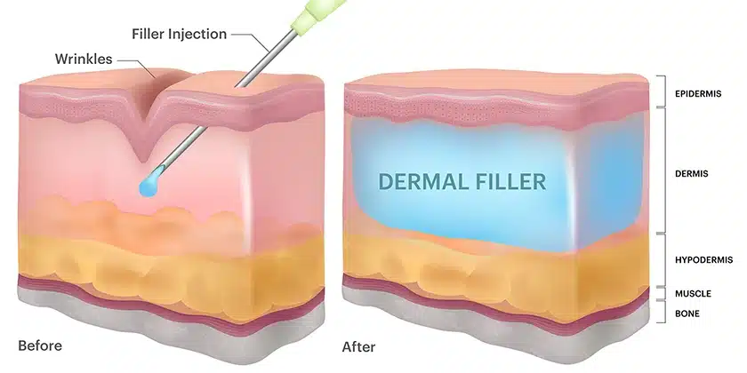 How Do Dermal Fillers Work?
