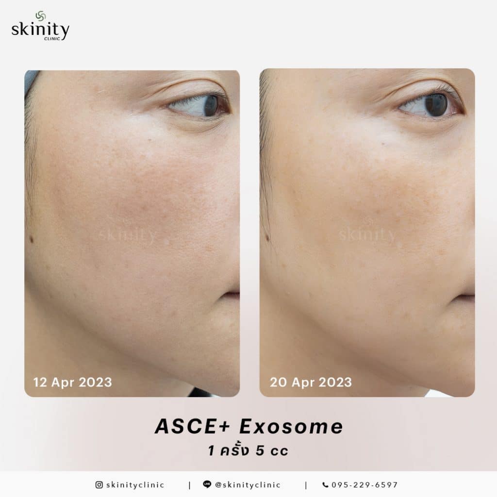 รีวิว Exosome