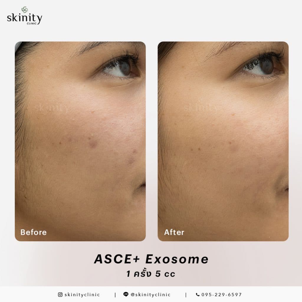 รีวิว Exosome