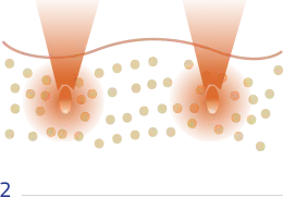 How Shurink HIFU / Ultraformer III Works