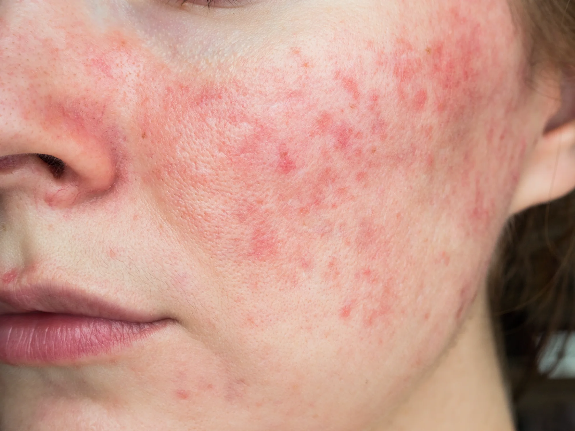 รอยแดงจาก Rosacea ควรพบแพทย์เพื่อรักษา